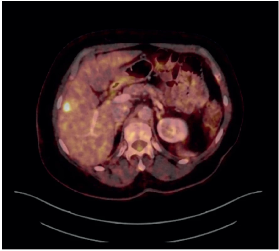 Fúzovaný obraz PET a CT ukazující vysokou metabolickou
aktivitu v ložisku v játrech<br>
Fig. 1. Fused PET/CT image showing high metabolic activity
in the liver lesion