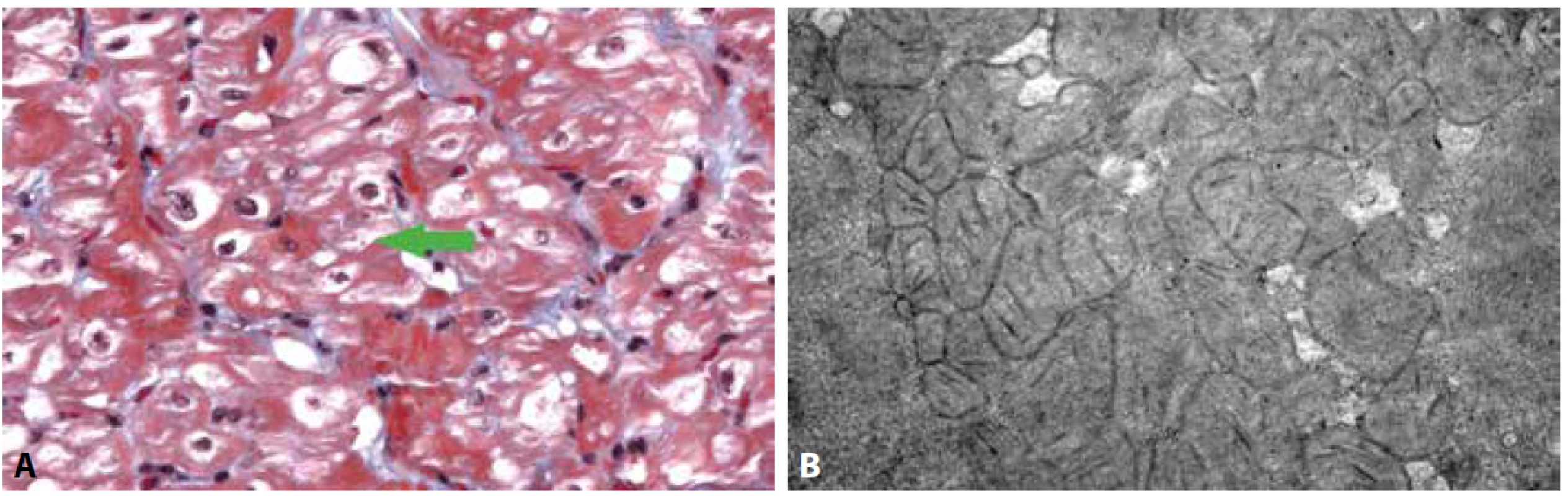 Kardiomyopatie u dítěte s vrozenou mitochondriální poruchou (mitochondriální kardiomyopatie).<br>
A: Vakuolizace kardiomyocytů s patrnými zmnoženými mitochondriemi a záchytem obřích mitochondrií (šipka) (Massonův trichrom, 400x).<br>
B: Ultrastruktura cytoplazmy kardiomyocytů s přítomností hojných atypických mitochondrií, které vykazují tvarové abnormality, paralelně uspořádané
kristy a denzní tělíska v mitochondriální matrix.