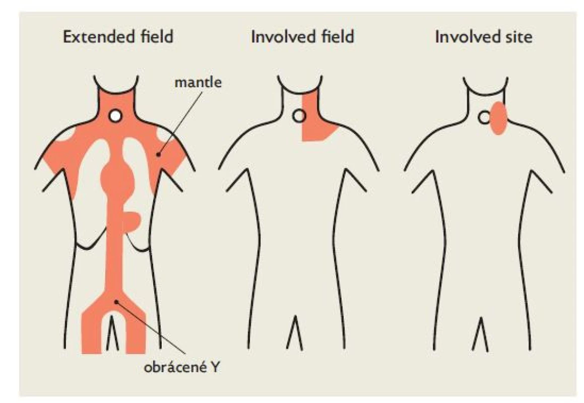 Srovnání velikosti ozařovacích polí u extended field, involved
field a involved site radioterapie