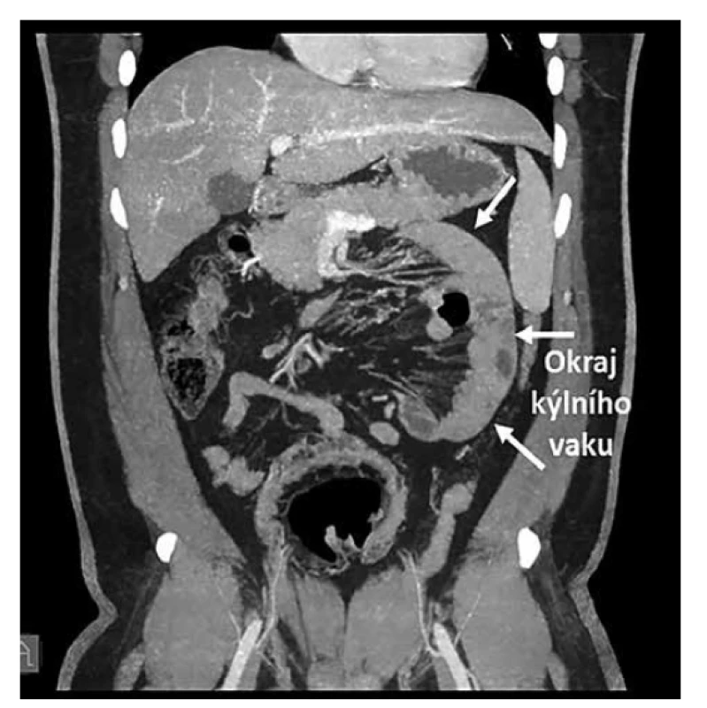 CT dutiny břišní, koronální projekce<br>
Fig. 4: CT of abdominal cavity, coronal projection