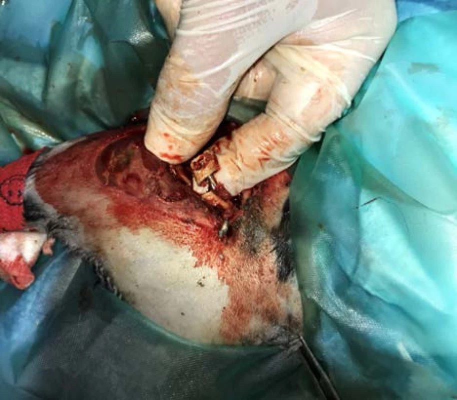 Surgical insertion of the implant.