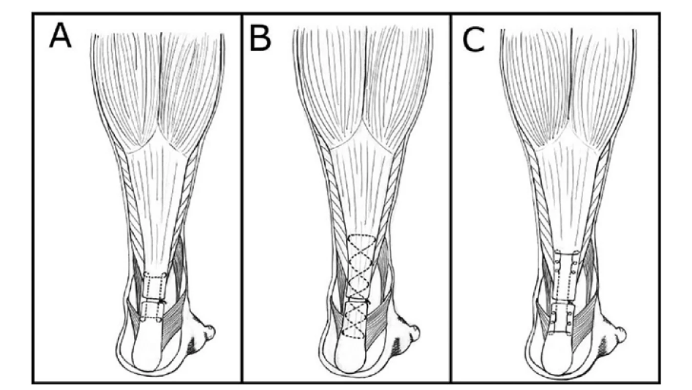 Přehled stehů Achillovy šlachy podle A – Kesslera, B – Bunnela, C – Krackowa<br>
Fig. 2: Achilles tendon sutures according to A – Kessler, B – Bunnel, C – Krackow