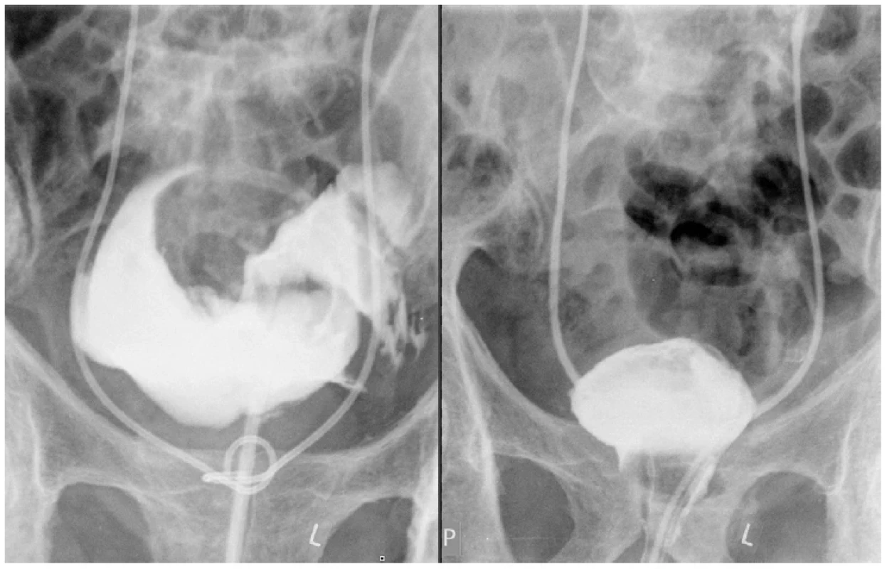Rtg cystografie, extraperitoneální ruptura močového měchýře v porovnání s kontrolní cystografií po
operační revizi <br> 
Fig. 1. X-ray cystography, extraperiteonal rupture of urinary bladder compared to control cystography after
surgical repair