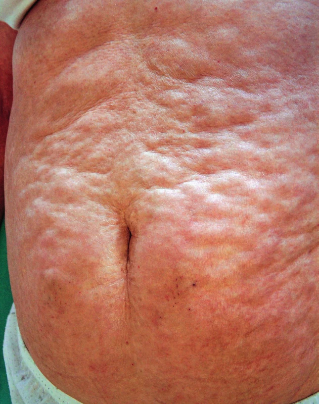 Obraz rozsáhlého postižení v oblasti břicha, typické je
dolíčkování v místech s anatomicky výraznější podkožní tukovou
tkání