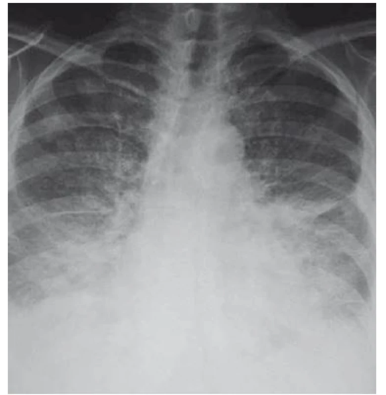 Lymfangoitida bilaterálně, intersticiální kresba
bilaterálně.<br>
Fig. 3. Lymfangitis bilaterally, interstitial drawing bilaterally.