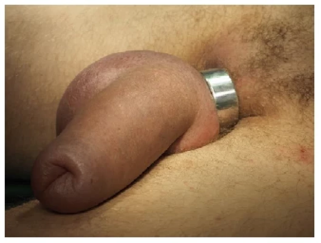 Strangulace zevního genitálu kovovým prstenem <br> 
Fig. 1. A penoscrotal strangulation by a metallic ring