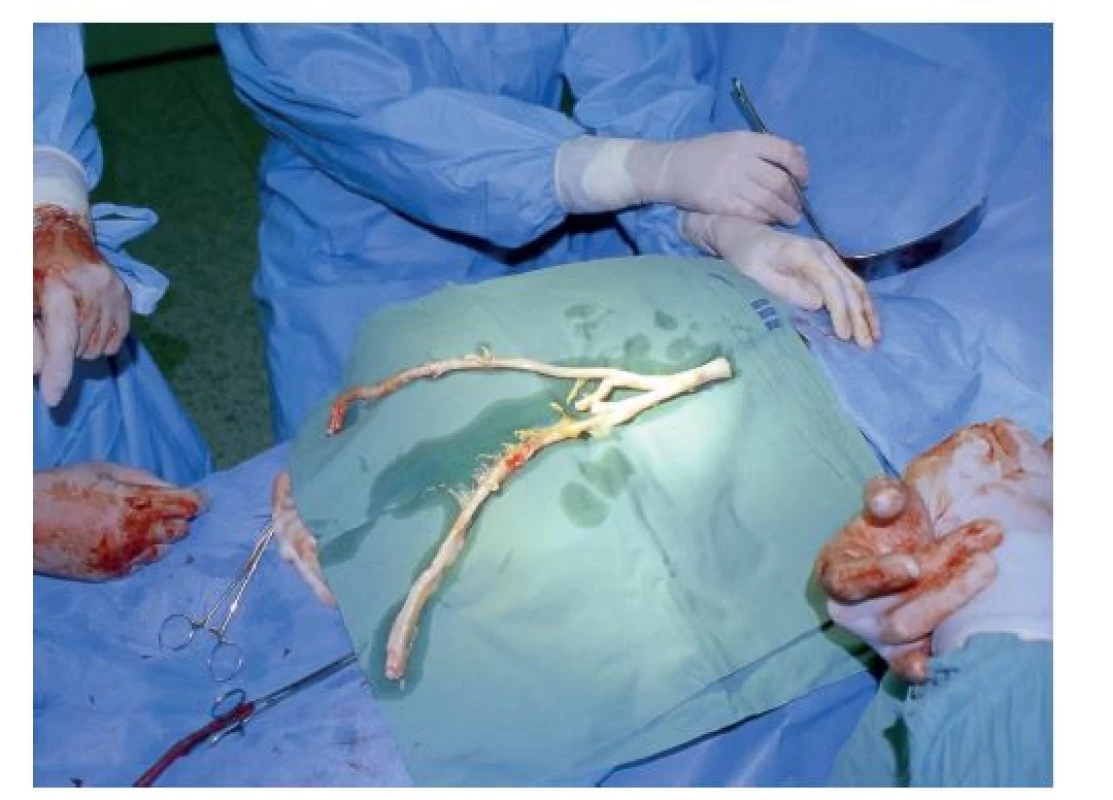 Čerstvý tepenný allograft<br>
Fig. 3: Fresh arterial allograft