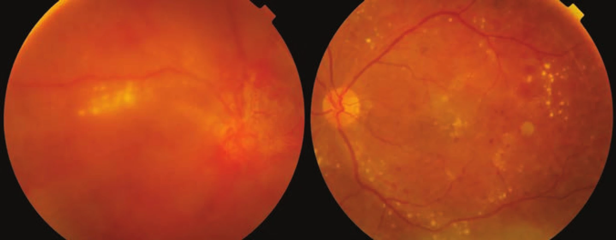 Photograph of ocular fundus of both eyes 3 months after childbirth
