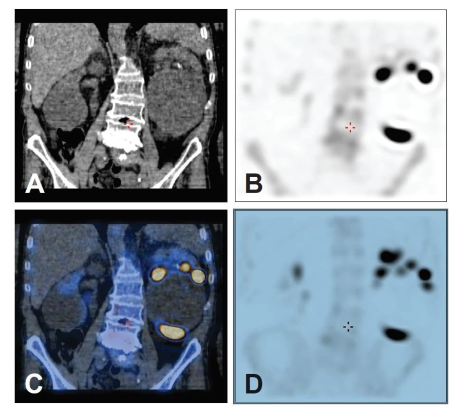 Na SPECT/CT oblasti břicha je na jednotlivých řezech ve frontální rovině vidět lokalizace
ložisek v měkkých tkáních v cystě ledviny (A – CT obraz, B – scintigrafický obraz,
C – hybridní obraz, D – MIP 3D scintigrafický obraz).<br>
Scintigrafie skeletu je metoda používaná k zobrazení změn kostního metabolismu pomocí
bisfosfonátových komplexů značených <sup>99mTc</sup>. Indikací jsou nádorová postižení skeletu i nenádorová
onemocnění (úrazy, osteomyelitida, diferenciální diagnóza kostních lézí). Vazba
radiofarmaka na kostní tkáň závisí na prokrvení a osteoblastické aktivitě.<br>
Metoda je vysoce senzitivní, ale nízce specifická. Alespoň částečně lze zvýšit specificitu
vyšetření provedením hybridního zobrazení SPECT/CT podezřelé oblasti. Díky jejímu detailnějšímu
zobrazení spolehlivě určíme polohu suspektního ložiska. Radiofarmakum je
akumulováno rovněž v měkkých tkáních (nekróza tkáně, žíly dolních končetin u pacientů
s chronickou žilní trombózou, osifikované vazy, kalcifikace v měkkých tkáních nebo cizích
tělesech – centrální žilní katétr). <sup>1</sup> Všechny tyto nálezy bychom mohli pouze podle planárních
snímků popsat jako falešně pozitivní.<br>
U kostních lézí je diferenciální diagnostika také širší. Kostní infarkt může imitovat osteosarkom,
ale může být i jeho projevem. <sup>2</sup> Dalšími kostními afekcemi připadajícími v úvahu jsou
osteomyelitida, benigní léze jako enchondrom, neosifikující fibrom. 2 Ložiska v žebrech mohou
často být jiného než metastatického původu, pravděpodobnost metastatického postižení
roste s vícečetností ložisek. <sup>3</sup> Metastázy mohou být těžko odlišitelné od jiných kostních
lézí i u vyšetření FDG – PET, např. u fibrózní kostní dysplázie, vzácněji u hemangiomu. <sup>4,5</sup>
Patologie skeletu může být náhodně zachycena také u vyšetření původně cílených k diagnostice
jiných onemocnění. Při scintigrafii značenými leukocyty se defektem akumulace
mohou projevit zánětlivé afekce, ale i Pagetova choroba. <sup>6</sup>