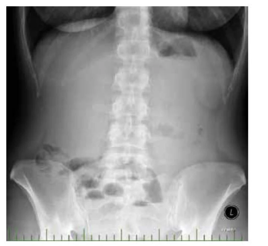 Prostý snímek břicha ve stoje<br>
Fig. 2: Simple abdominal X-ray in the standing position
