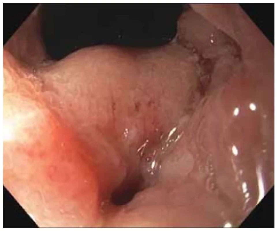 Ústí píštěle či sinusu směřující ventrálně. <br> 
Fig. 2. Mouth of fi stula or sinus directed ventrally.