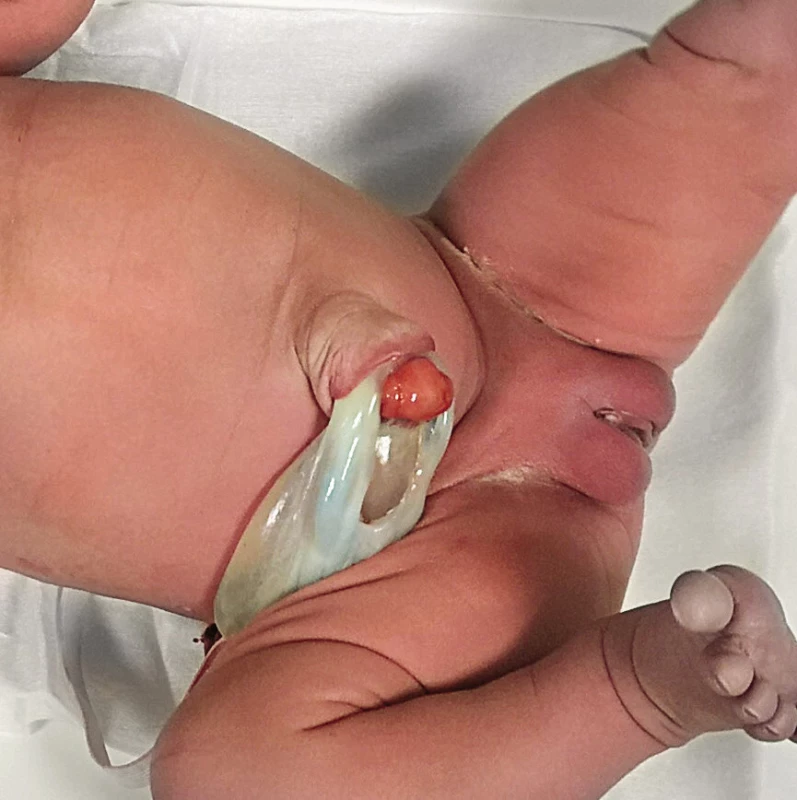 Dutina v pupečníku při odstupu z břišní stěny,
pozůstatek prenatálně zobrazené cysty