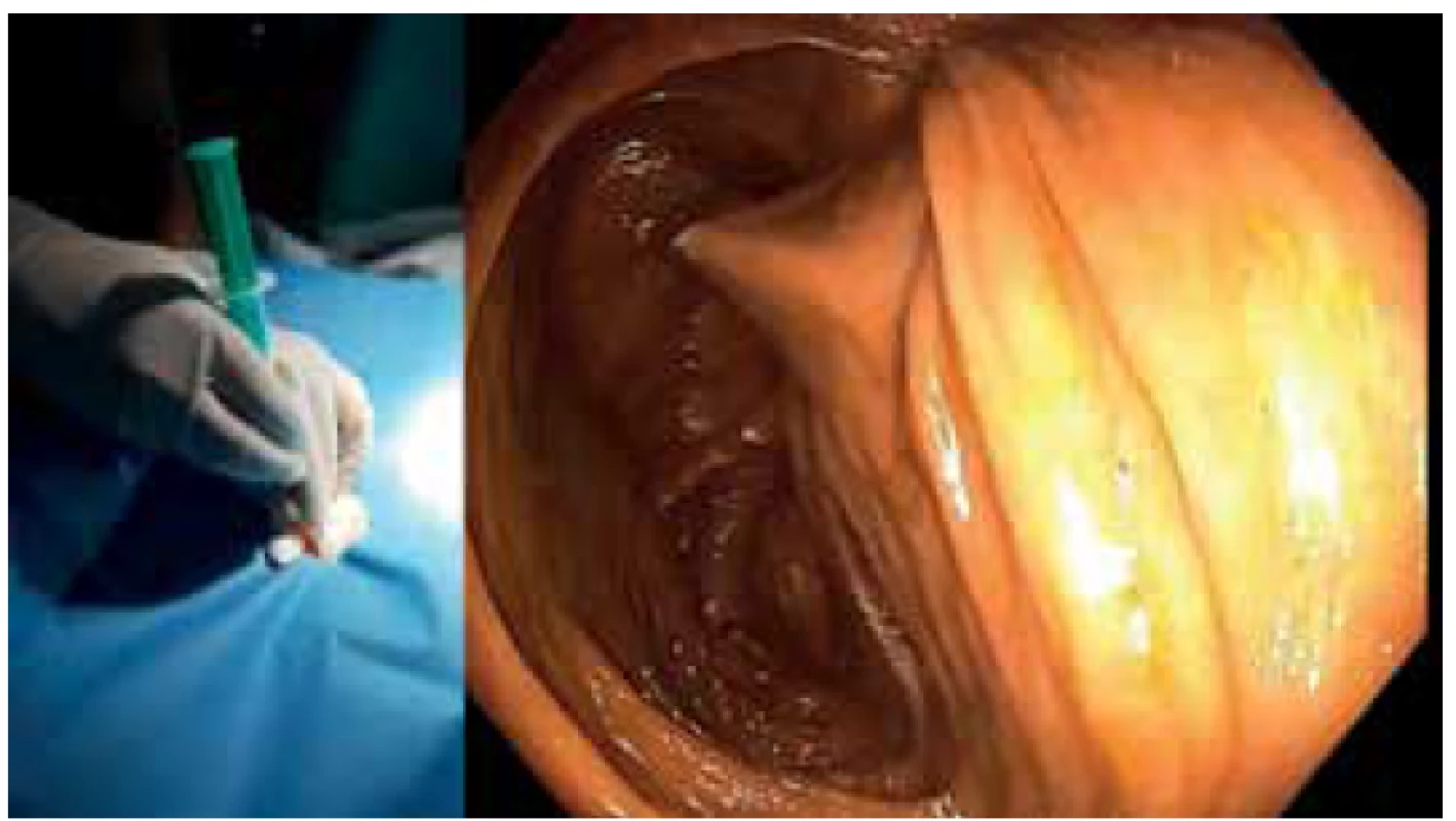 Punkce céka Seldingerovou jehlou (vlevo); koloskopický
pohled (vpravo)<br>
Fig. 3. Cecal puncture with the Seldinger needle (left); colonoscopic
view (right)