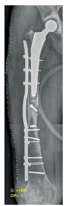 Pooperační RTG – 3. reoperace
(předehnutá dlaha)<br>
Fig. 9: Postoperative X-ray – the 3rd revision
surgery (wave plate)