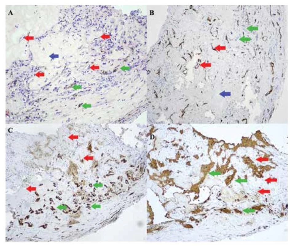 Histologický nález, imunohistochemické farbenie s hematoxylínom – eozínom,
zväčšenie 20x (A), s protilátkou CD 34, zväčšenie 10x (B), s protilátkou S-100, zväčšenie 10x
(C), s protilátkou GFAP (gliálny fibrilárny proteín), zväčšenie 10x (D), červené šípky – vazoproliferácie,
modré šípky – hyalinizovaná stróma, zelené šípky – reaktívna proliferácia gliálnych
buniek s melanínovým pigmentom