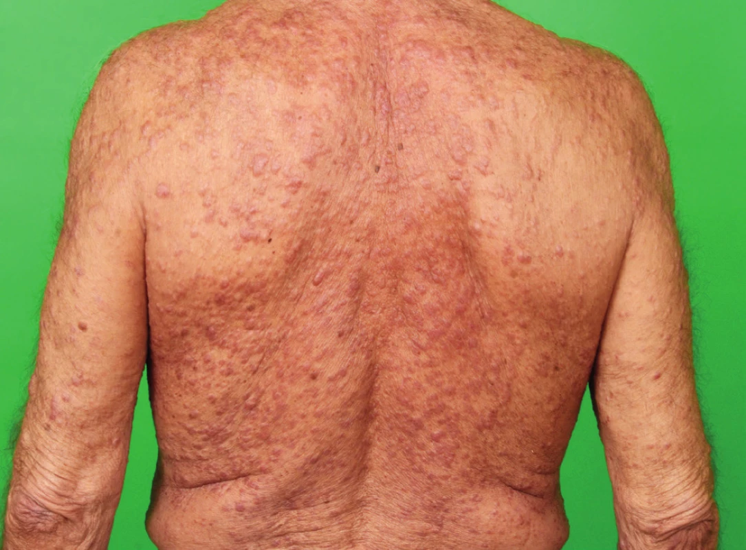 Postižení kůže zad při indeterminate-cell histiocytosis