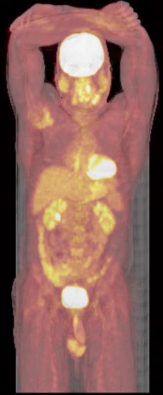 FDG-PET/CT trupu, bez průkazu další patologické akumulace FDG
a tedy bez průkazu dalšího ložiska fibrózní dysplazie