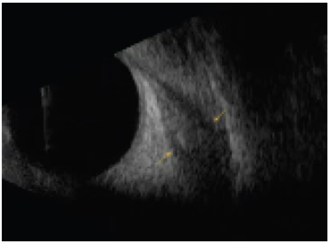 Enlargement of rectus muscle in patient with thyroid-
-associated orbitopathy in active phase of disease during treatment
(muscle is still edematous) in view B, longitudinal view