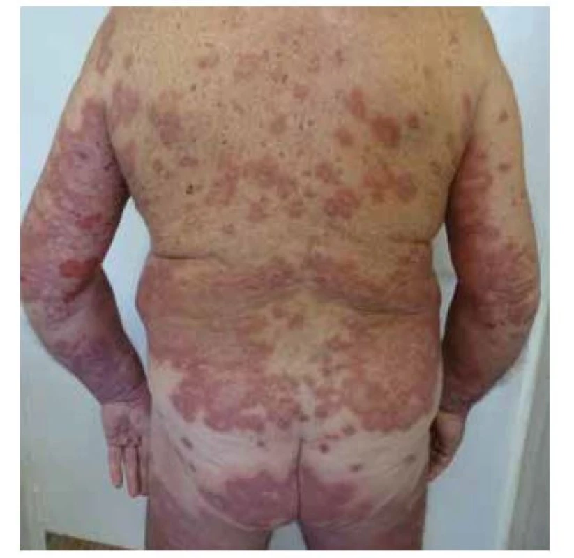 Exacerbace dříve diagnostikovaného pemfigoidu po
vakcinaci
