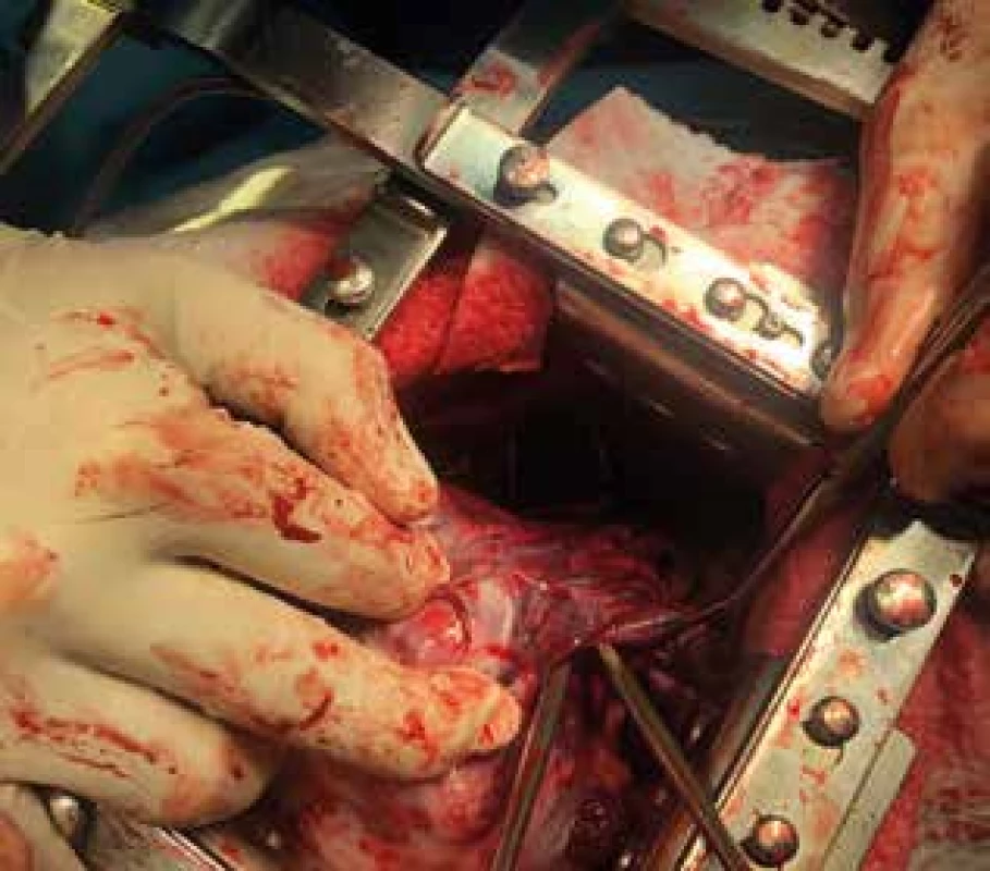 Dolní lalok pravé plíce infiltrován tumorem<br>
Fig. 3: Right lower lung lobe infiltrated with tumor