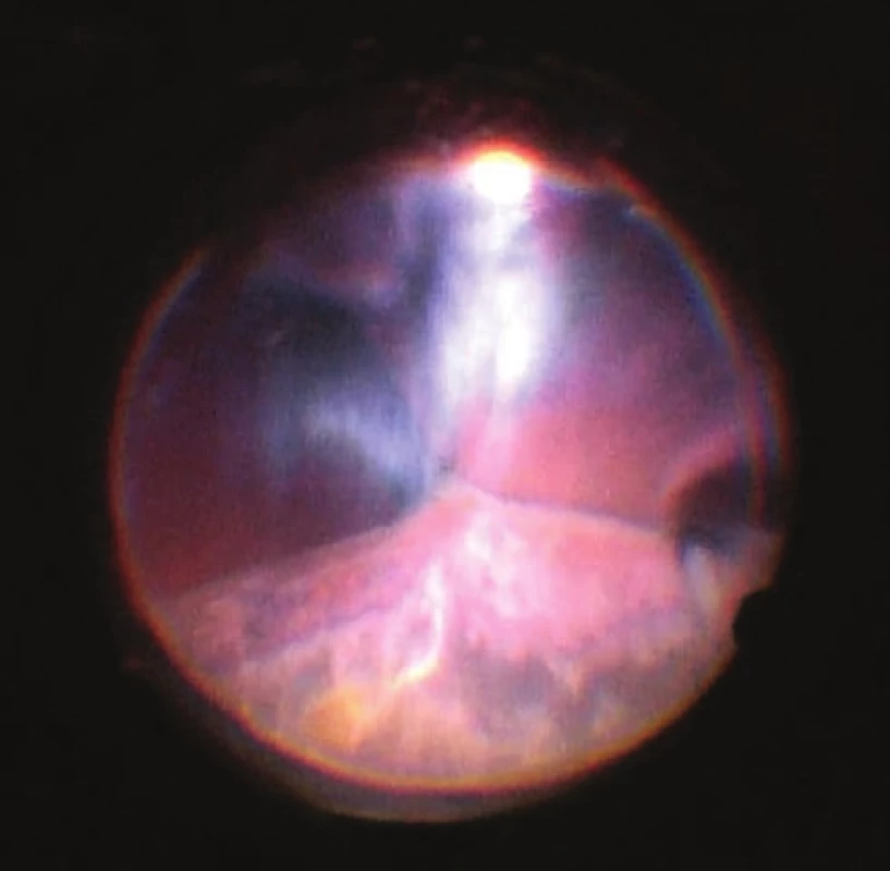 View of ocular fundus during the course of progressive
reduction of height of ablations, apposition of opposite
parts of retina gradually “unpeeled”, reflex from ocular
fundus begins to be visible. Light is reflected from vitreous
fibres which are squeezed into the retrolental space. Image
from perioperative video – from surgeon’s view