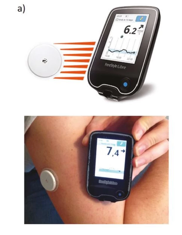 a. „Okamžitá“ monitorace glukózy (intermittent scanning CGM –
isCGM). a) zavedení monitoru do podkoží na paži pacienta, přičemž data se
zobrazí po přiložení čtečky (skenování). Čtečka je schopna zobrazit aktuální
glykemii, trendové šipky, ale i graf glykemií za posledních 8 hodin