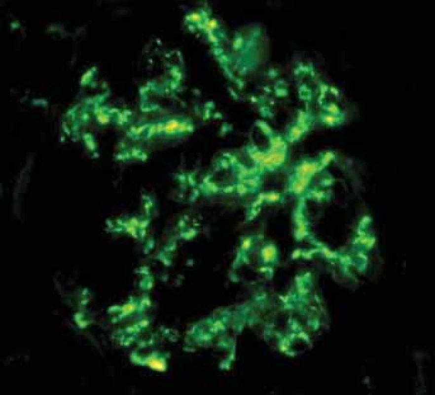 Histologické nálezy u pacientõ s IBD a renálním postižením (tubulointersticiální nefritida, glomerulonefritida, AA amyloidóza).<br>
Fig. 3. Biopsy pictures in IBD patients with renal illness
(tubulointerstitial nephritis, glomerulonephritis,
AA amyloidosis).