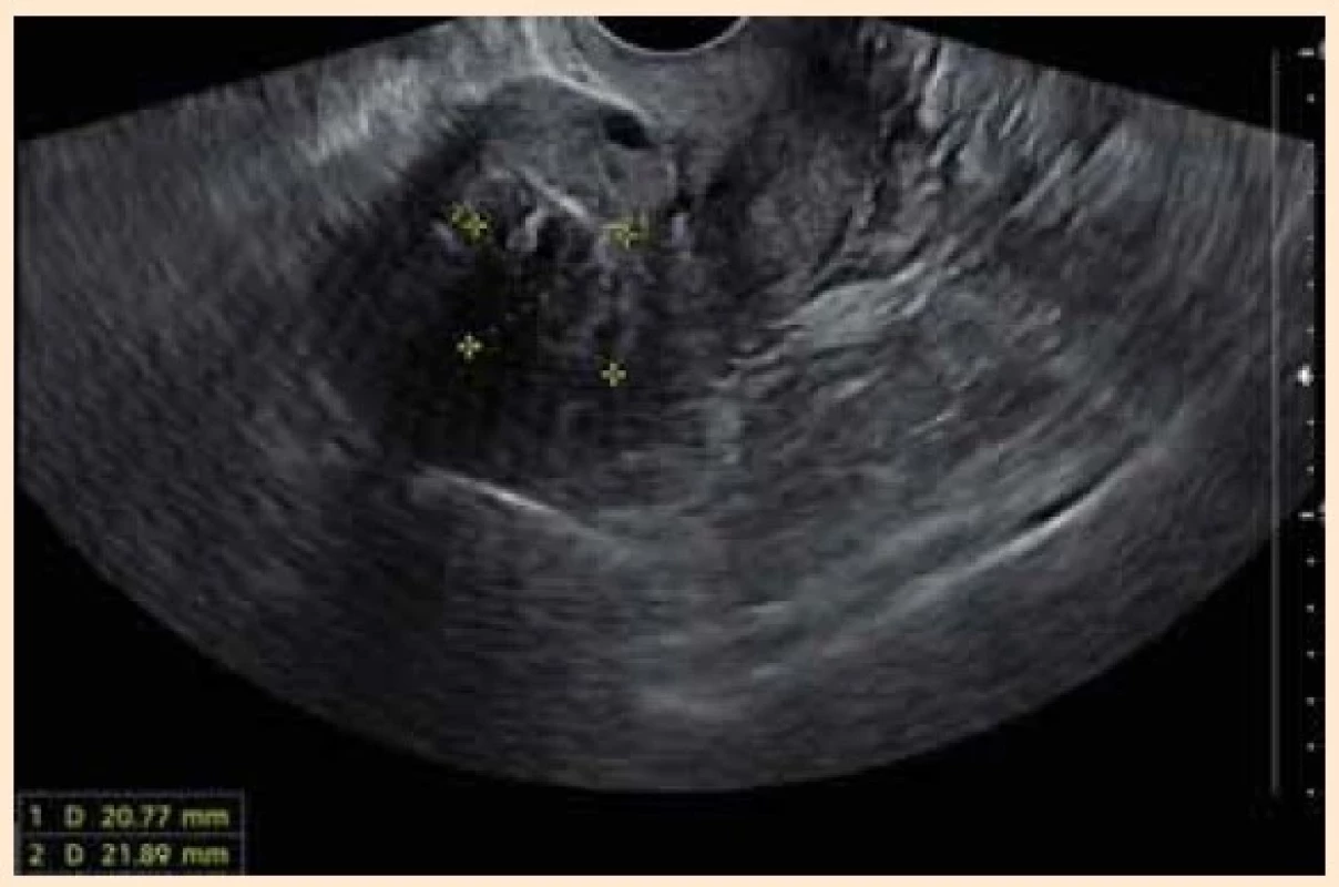 Fig. 2. Sagittal sonographic view of the uterus with a decreased
size of the leiomyoma after treatment with Relugolix
add-back therapy.<br>
Obr. 2. Sagitální sonografické zobrazení dělohy se
zmenšenou velikostí myomu po terapii Relugolixem
s kombinovanou terapií.