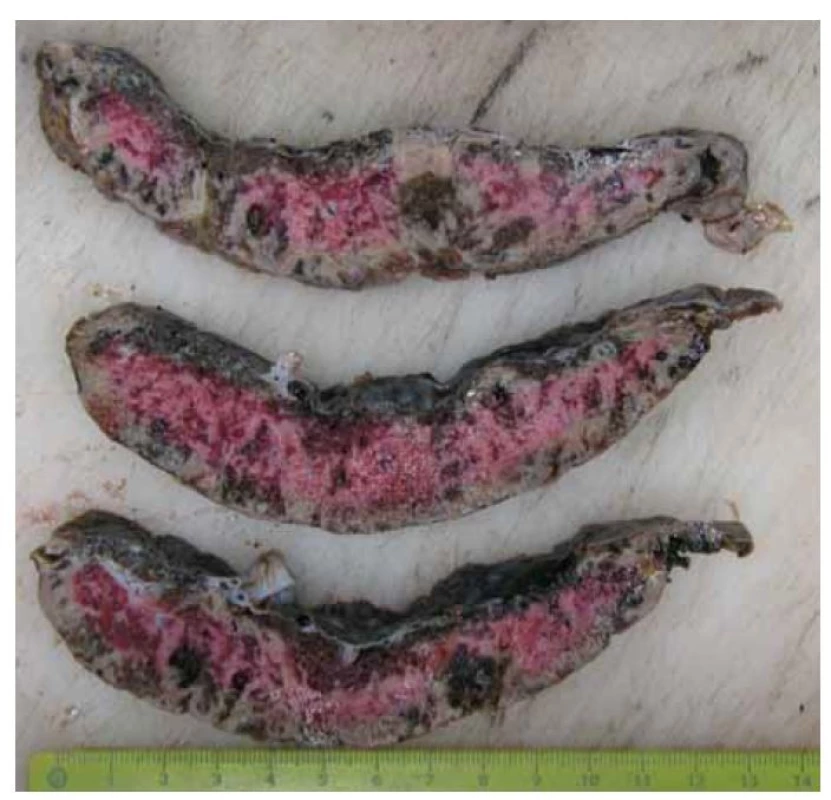 Případ č. 2. Placenta předčasně porozeného plodu (28+1) s makroskopicky
patrnými ložisky perivilózního fibrinoidu.<br>
Fig. 2. Case No. 2. Placenta of a preterm newborn (28+1) with macroscopically evident
perivillous fibrinoid deposits.