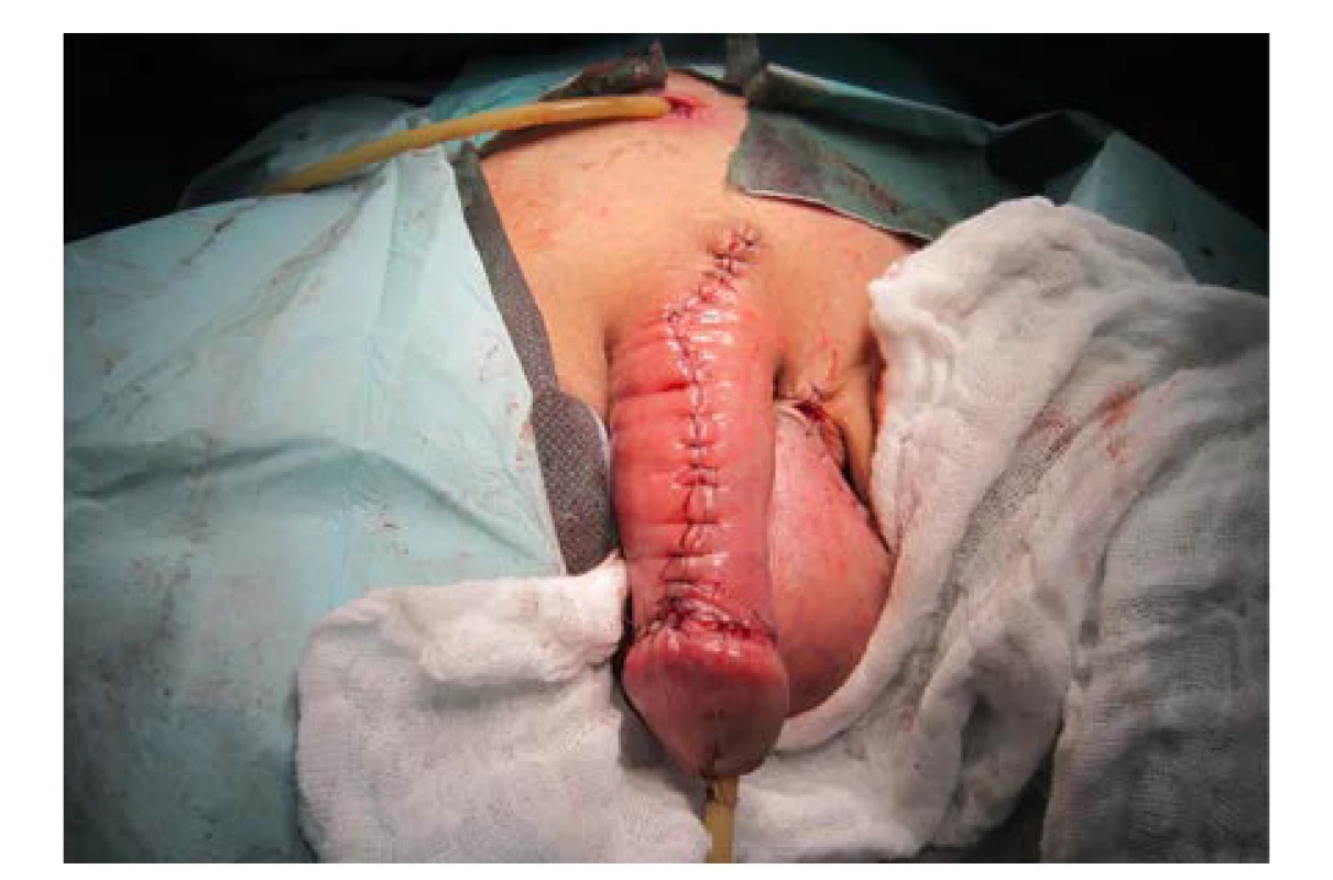 Dorzální strana penisu, finální stav po sutuře<br>
Fig. 11. The dorsal side of the penis; the final state after
suturing