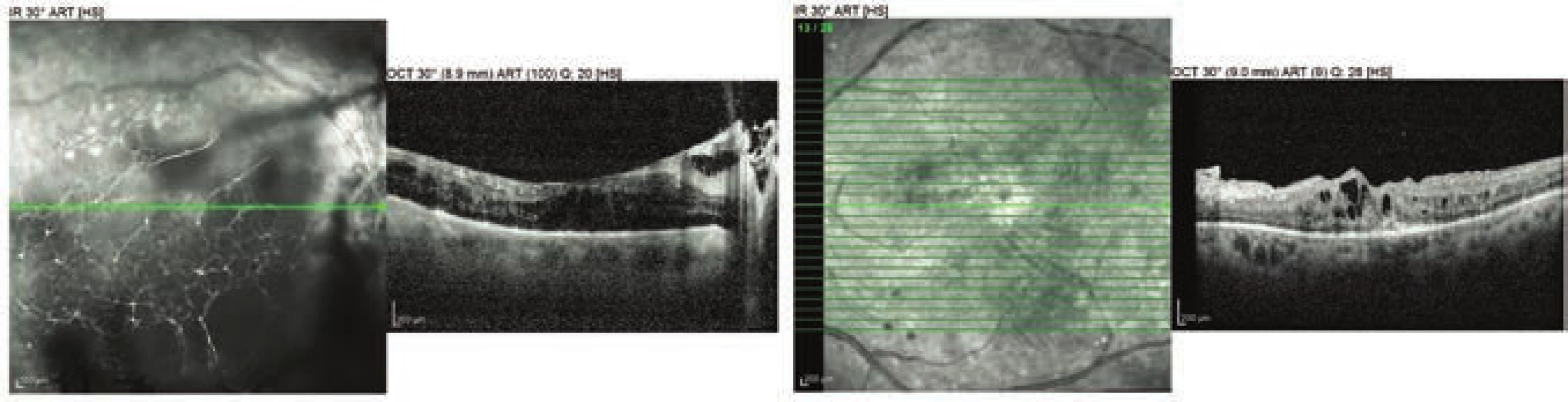 OCT examination of both eyes 3 months after childbirth
