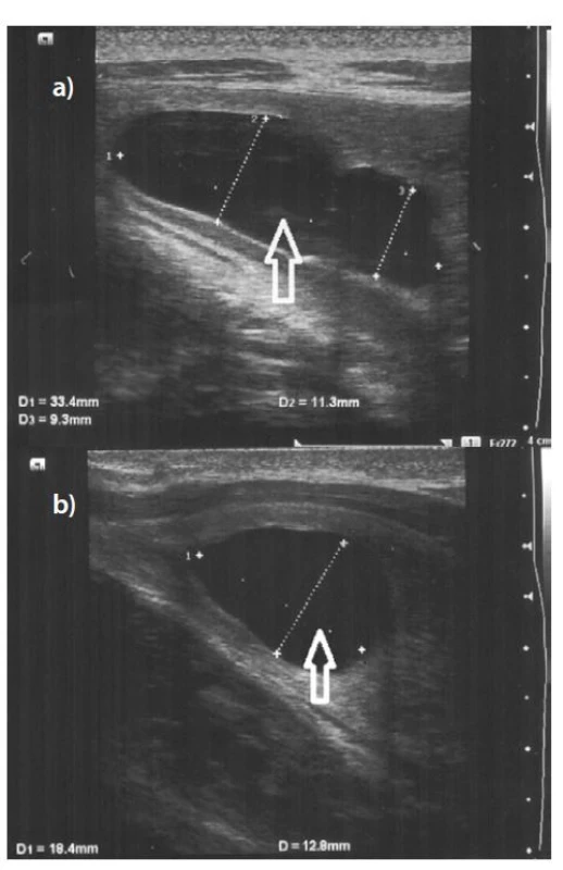 a, b. Vstupní USG bulbární uretry: anechogenní
cystická formace spongiózního tělesa bulbu
(Littrého žláza) (šipka) uložena ventrálně od močové
trubice<br>
Fig. 2a, b. Baseline ultrasound of the bulbar urethra:
an anechogenic cystic mass in the spongy body of
the bulb (Littré’s gland) (arrow) situated ventrally to
the urethra