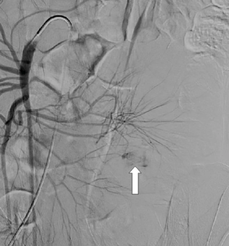  CT angiografia: leak kontrastnej látky do oblasti proximálneho jejuna 