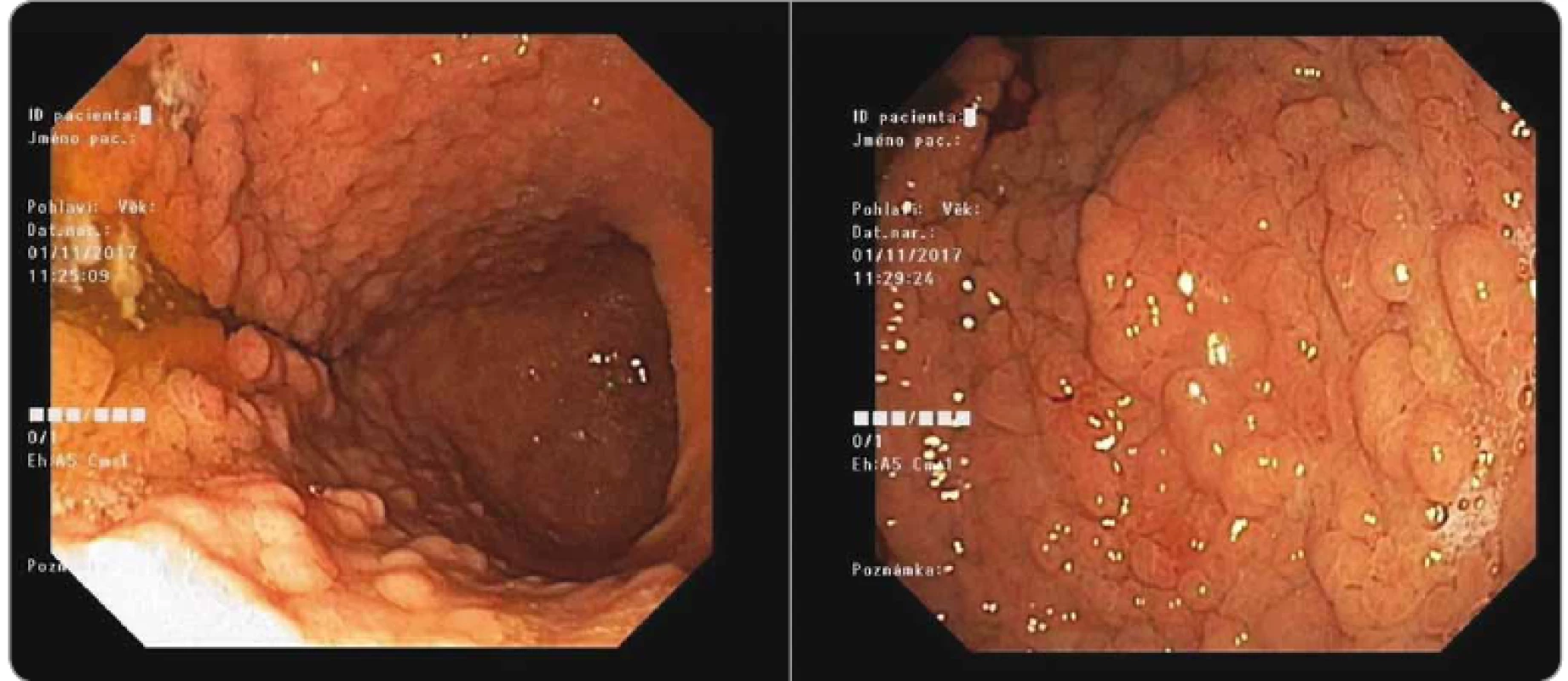 Gastroscopy with massive polyposis of stomach in gastric adenocarcinoma and proximal polyposis of the stomach patient
(Masaryk Memorial Cancer Institute).