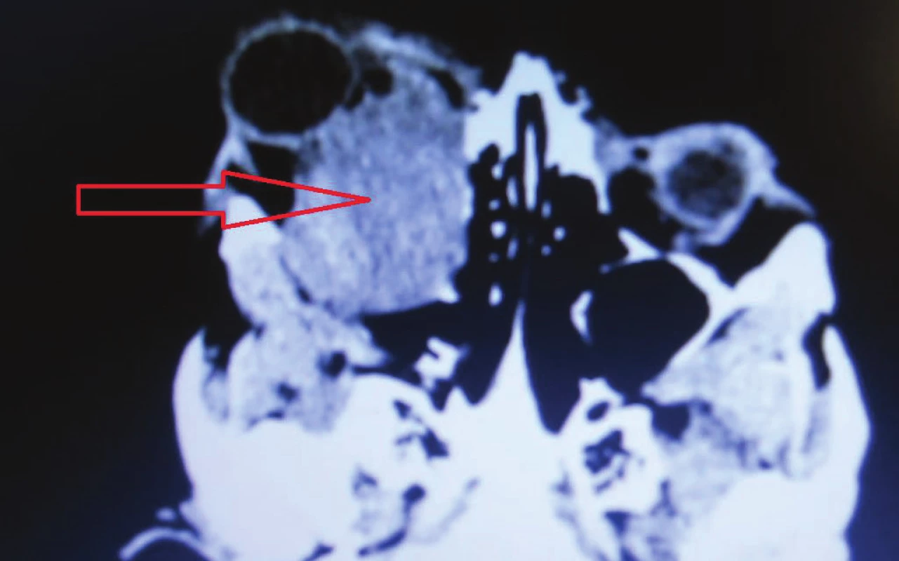 MRI findings with tumor masses arising from chiasm to the
orbit in 12/2015