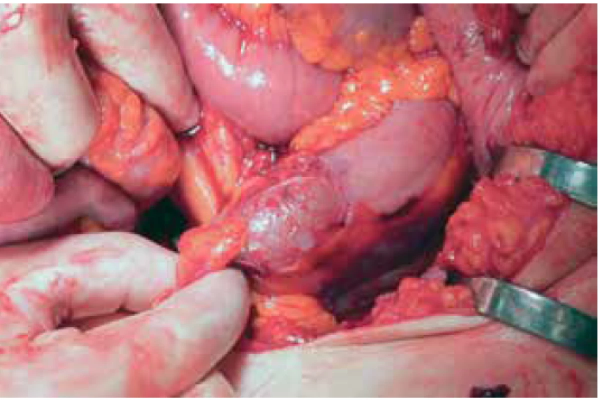 Trhlina střevní stěny bez kompletního porušení
integrity<br>
Fig. 2. A non-full-thickness laceration of the intestinal
wall