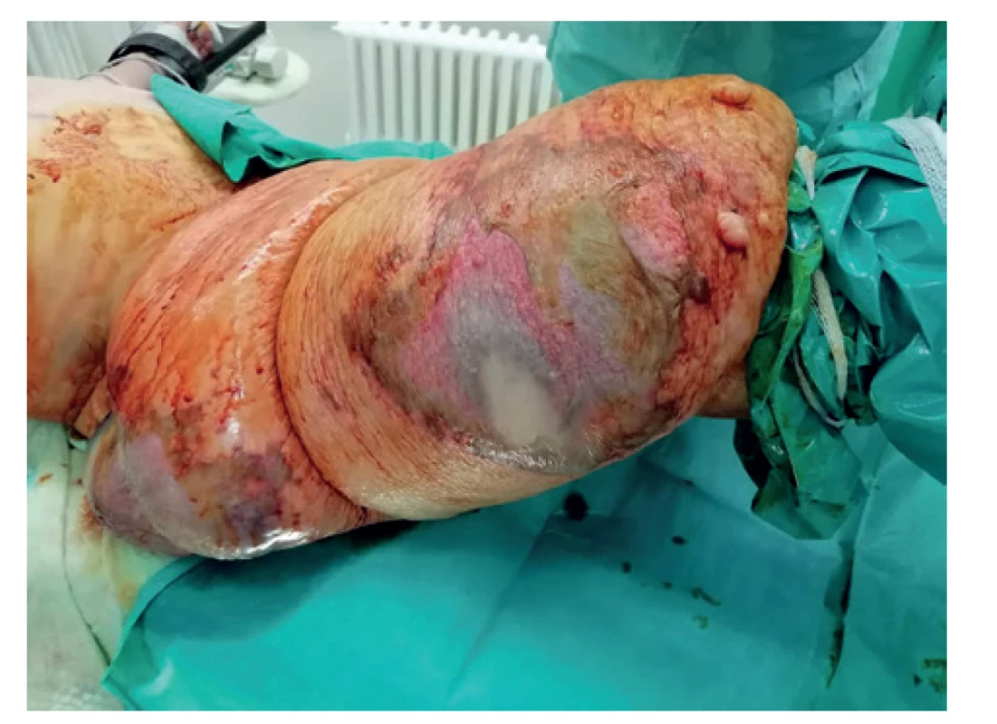 Zápalové zmeny kože pravej dolnej končatiny v teréne
lymfedému<br>
Fig. 1: Inflammatory changes of the right lower limb skin
in the field of lymphoedema