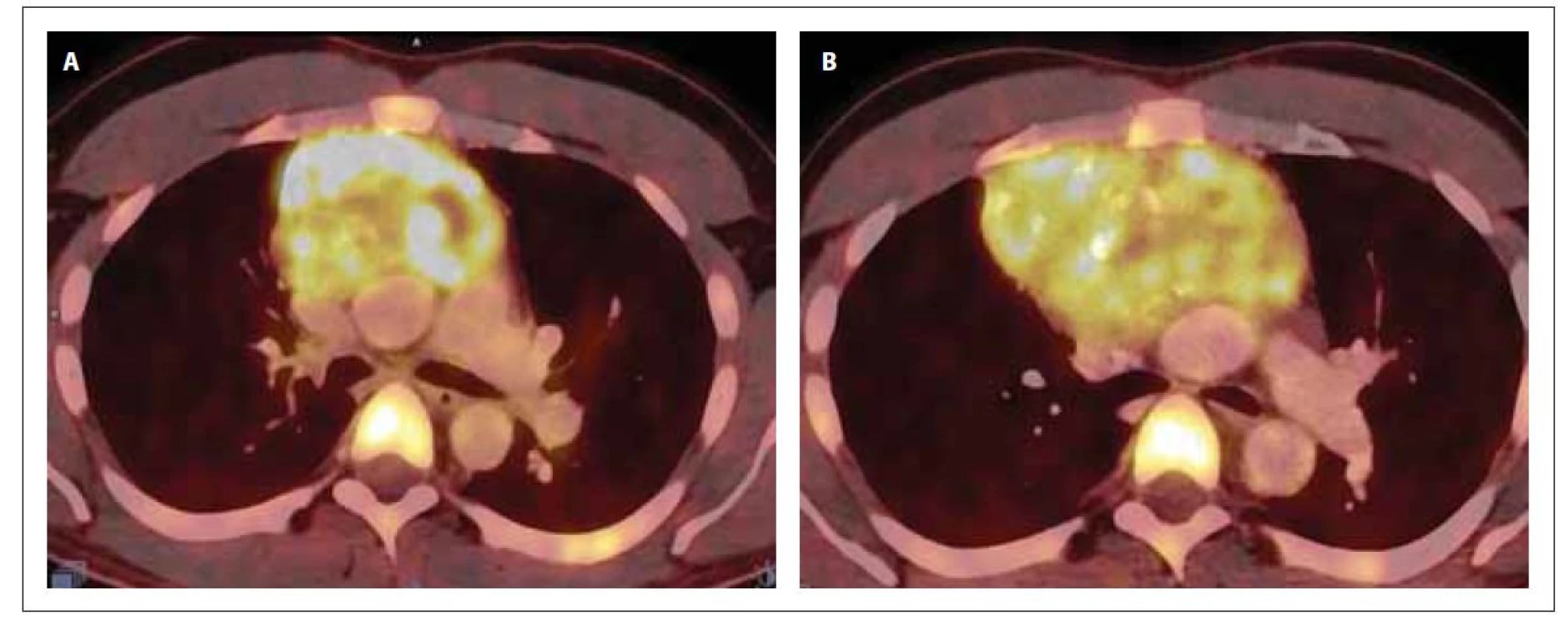 PET/CT mediastina v době diagnózy (A) a po 1. indukci (B). Na snímku A je přítomna zvýšená akumulace 18F-FDG
v předním mediastinu vel. 87 x 62 x 84 mm (SUVmax 13,6), ložisko lehce komprimuje levou brachicefalickou žílu a horní
dutou žílu. Snímek B prokazuje progresi ložiska v mediastinu (vel. 117 x 87 x 116 mm, SUVmax 10,2), dále akumulaci
18F-FDG v jedné lymfatické uzlině paraesofageálně vlevo a jedné retroesofageálně velikosti do 11 mm (SUVmax 4,5)
a v několika lymfatických uzlinách za bráničními crus velikosti do 9 mm (SUVmax 4,6).