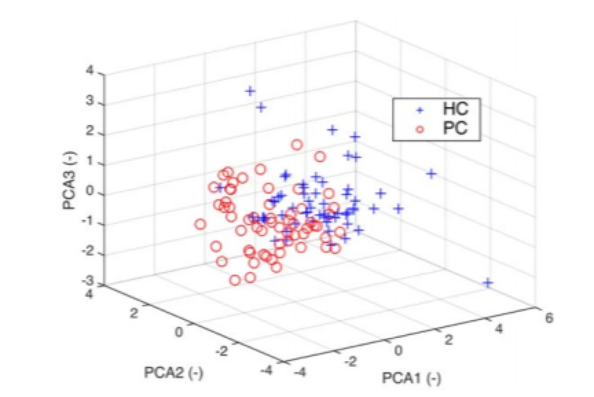 3D PCA space with visible clusters for HC and
PD. The 3D plot uses the first three principal
components which contain 80% of the original data
variability.