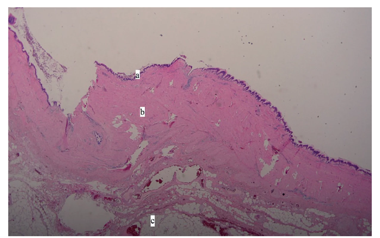 Histologický nález: a – epitel (cylindrický s řasinkami), b – stěna cysty, c – tuková tkáň
(Barvení H&E, zvětšeno 40x, autor: Z. Špůrková)<br>
Fig. 2: Histology image: a – epithelium (ciliated cylindrical), b – cyst wall, c – fat tissue
(H&E staining, 40x magnification, author: Z. Špůrková)