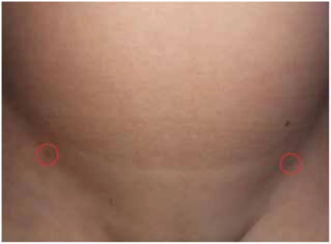 Zhojené vpichy na kůži<br>
Fig. 9: Healed wounds