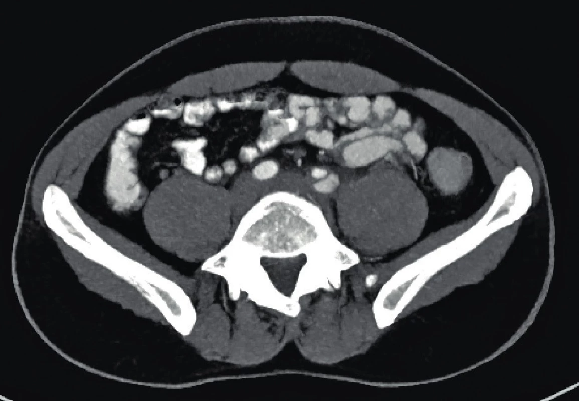CT angiografie, transverzální zobrazení disekce a. iliaca
vlevo