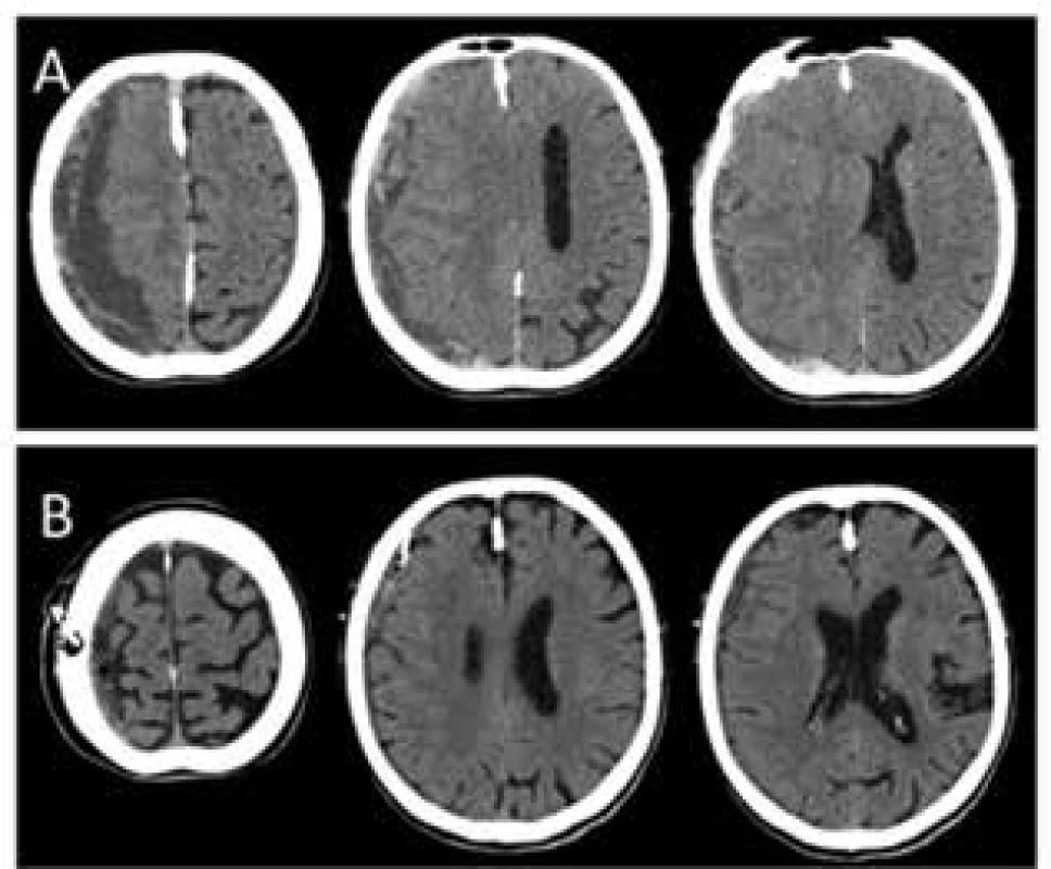 : A − septovaný, převážně hypodenzní chronický
subdurální hematom; B −stav po drenáži subdurálního
hematomu s minimálním reziduem<br>
Fig. 1: A − multilobulated, predominantly hypodense
chronic subdural hematoma; B − postoperative CT after
evacuation of chronic subdural hematoma with minimal
residuum