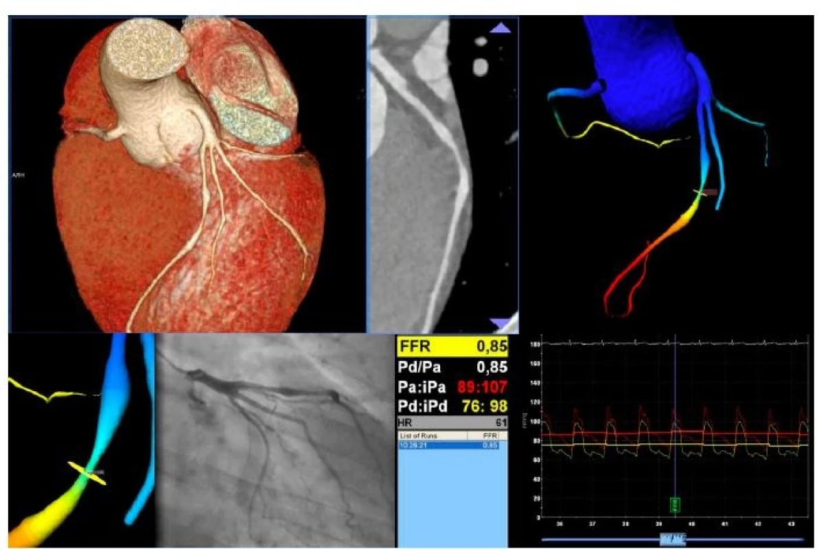 Stenóza ramus interventricularis anterior mezi naopak dilatovanými úseky na CCTA s velmi obtížnou kvantifikací stenózy (A, B). Při stanovení frakční průtokové rezervy provedené na základě CT obrazů potvrzena hemodynamicky nevýznamná stenóza (C, D). Totožný výsledek (0,85) stanovení frakční průtokové rezervy při invazivním vyšetření (E, F).