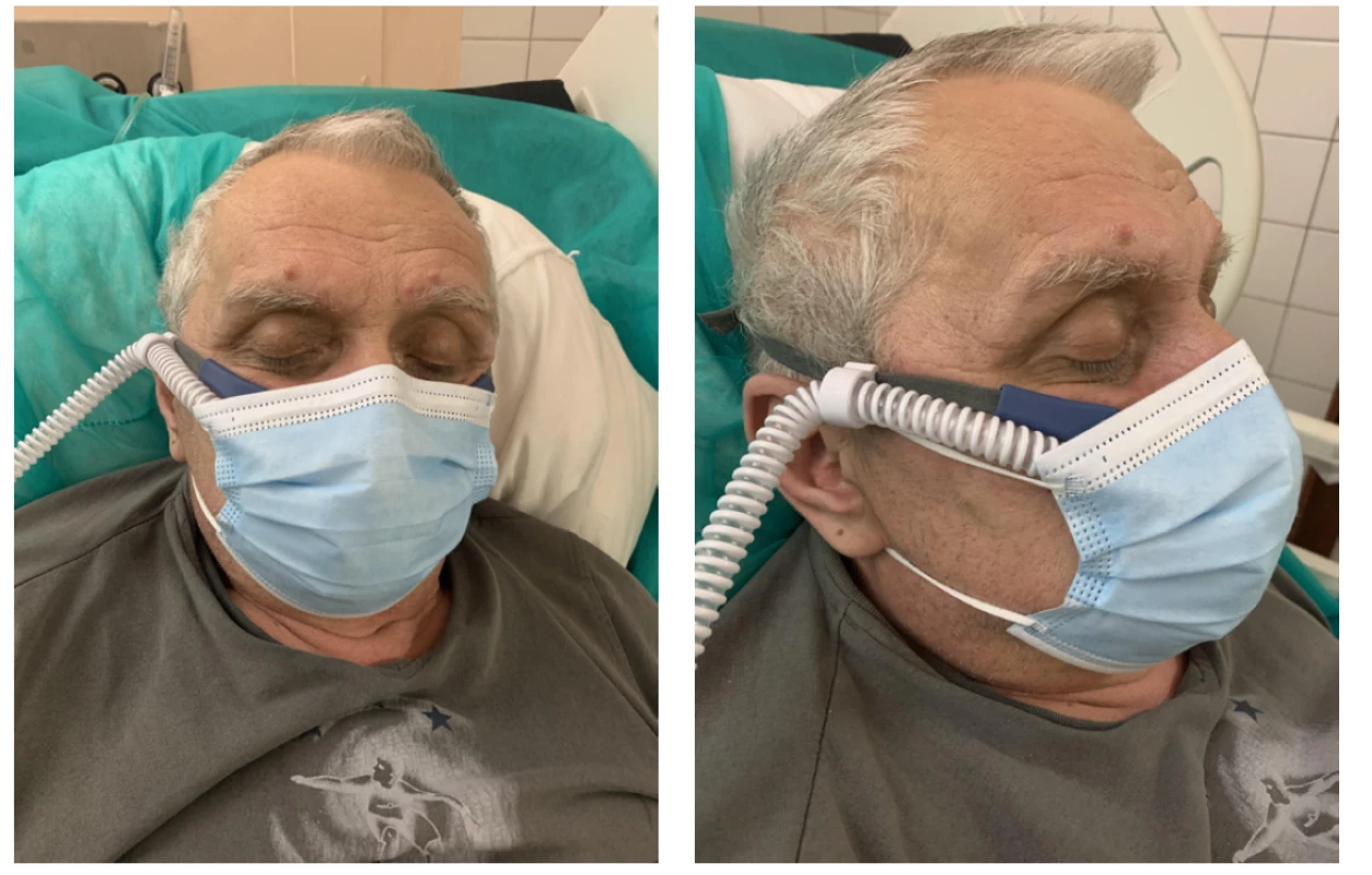 Pacient s HFNC a nasadeným chirurgickým rúškom počas testu. Chirurgické rúško prekrýva nos, ústa a bradu. Pacient leží v semi-Fowlerovej
polohe – hlavová časť postele je elevovaná 30 ° až 45 °