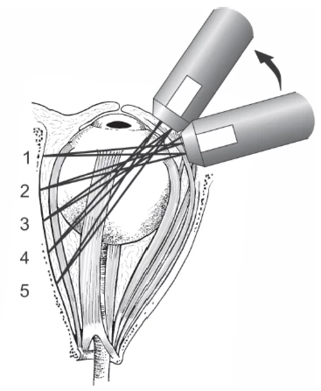 Probe position in dynamic B-scan imaging when examining
rectus muscle from its attachment (1) to orbital apex (5)
– transverse image
