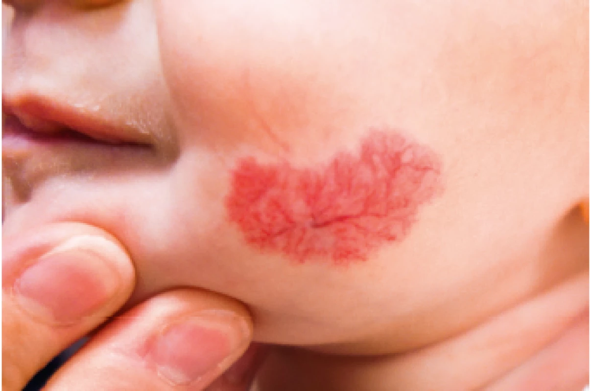 Reziduální teleangiektázie po involuci IH.<br>
Residual telangiectasia after IH involution.