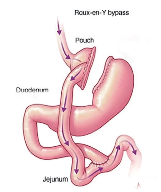 Roux-Y gastrický bypass<br>
Fig. 1: Roux-Y gastric bypass