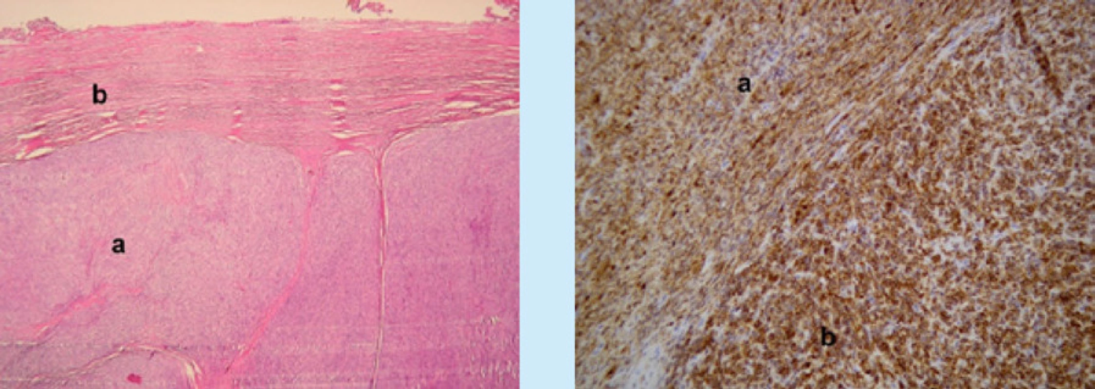 Mikroskopické obrazy STUMP s imunohistochemickým barvením. Vlevo (zvětšení 200×, Ki67) nízká proliferační
aktivita v dobře diferencovaných úsecích (a), jádra buněk v proliferační fázi mají hnědé zbarvení. V úsecích s odlišnou
morfologií je patrné zvýšení proliferační aktivity (b). Vpravo (zvětšení 200×, průkaz hladkosvalového aktinu, Smooth
Muscle Actin, SMA) dobře diferencované úseky nádorové tkáně tvořené vřetenitými buňkami jsou pozitivní, pozitivní
reakce je vizualizovaná hnědým zbarvením nádorových elementů (a), v nízce diferencovaných úsecích nádorového
ložiska tvořené buňkami s odlišnou morfologií je reakce negativní (b)<br>
Fig. 2. Microscopic images of STUMP with immunohistochemical staining. On the left (magnification 200 ×, Ki67)
low proliferative activity in well-differentiated sections (a), cell nuclei in the proliferation phase are brown in color. In
sections with different morphology, an increase in proliferative activity is evident (b). On the right (magnification 200 ×,
detection of smooth muscle actin, SMA) well-differentiated sections of tumor tissue formed by spindle cells are positive,
positive reaction is visualized by brown staining of tumor elements (a), in low-differentiated sections of tumor deposit
formed by cells with different morphology is a negative reaction (b)