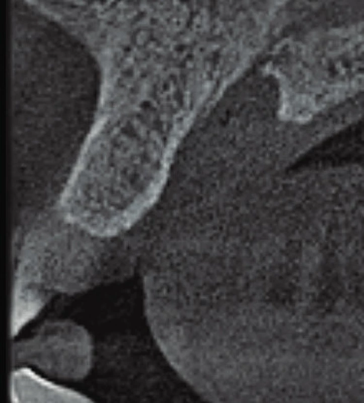 Axiální řez CBCT
snímku v mediánní rovině.
Rozšíření nazopalatinálního
kanálu je viditelné zvláště
při palatinálním vyústění
kanálu